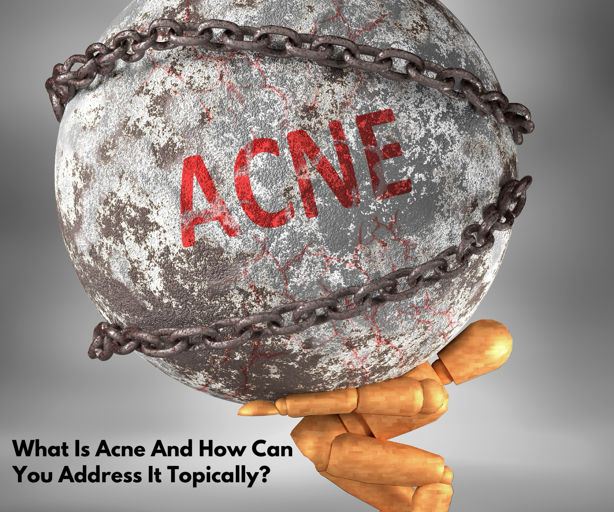 What Is Acne And How Can You Address It Topically?